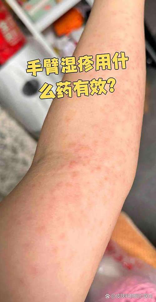 孕期手臂痒是皮肤问题还是激素变化？需要警惕哪些潜在风险？-第1张图片-郑州医学网