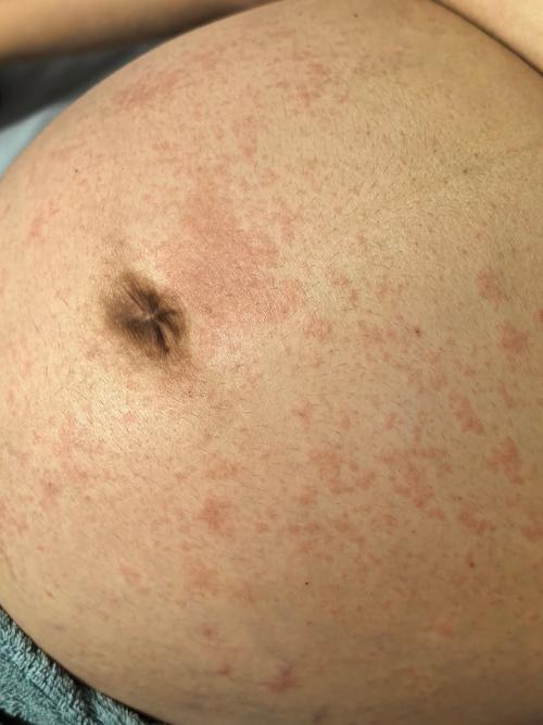 孕期肚子有红点点不痒-第1张图片-郑州医学网