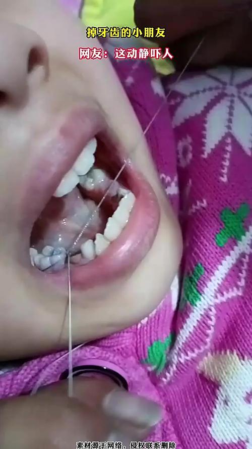 儿童牙齿掉了牙根还在，是正常现象还是隐藏口腔问题？-第1张图片-郑州医学网