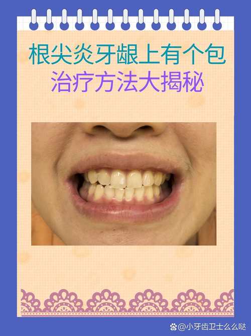 急性根尖炎孕期怎么治-第1张图片-郑州医学网
