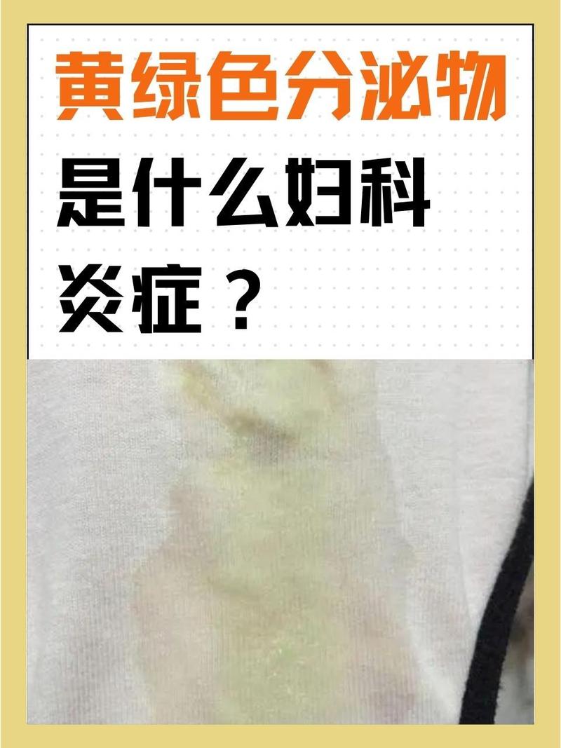 怀孕期间白带发黄发绿是感染了吗？对胎儿有影响吗？-第2张图片-郑州医学网