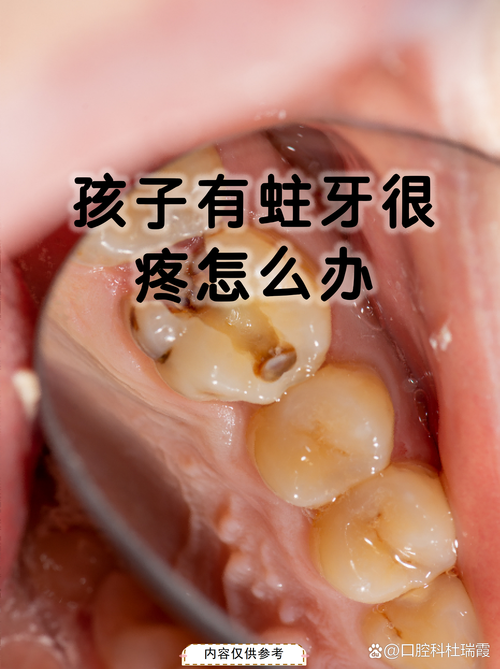孕期蛀牙引发牙神经痛，到底该怎么办才能不伤胎儿？-第1张图片-郑州医学网