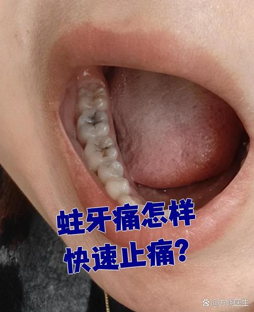孕期蛀牙引发牙神经痛，到底该怎么办才能不伤胎儿？-第2张图片-郑州医学网