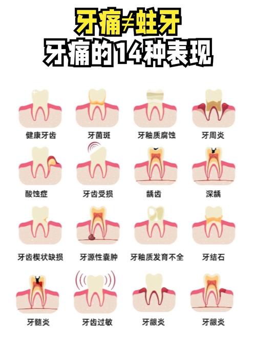 孕期蛀牙引发牙神经痛，到底该怎么办才能不伤胎儿？-第3张图片-郑州医学网