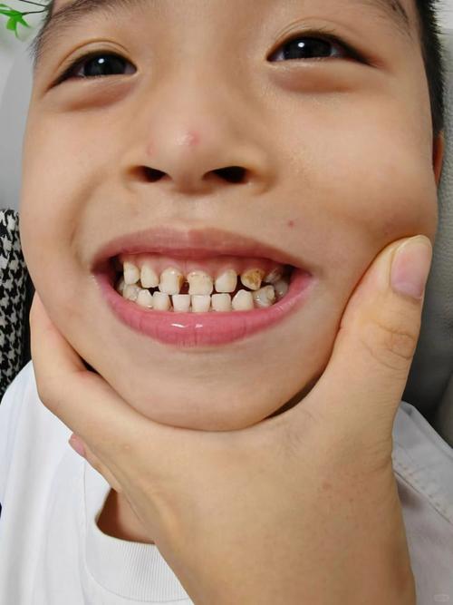 儿童龋齿图片和虫牙有何区别？如何通过图片识别儿童龋齿发展阶段？-第1张图片-郑州医学网