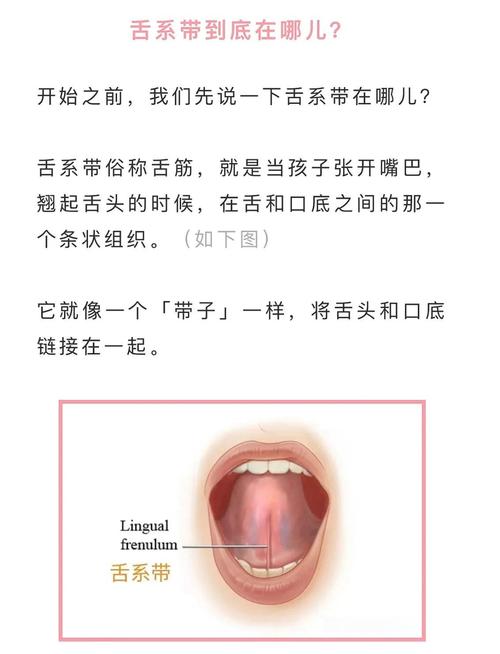 新生儿舌系带过短该挂哪个科？需要手术矫正吗？-第1张图片-郑州医学网