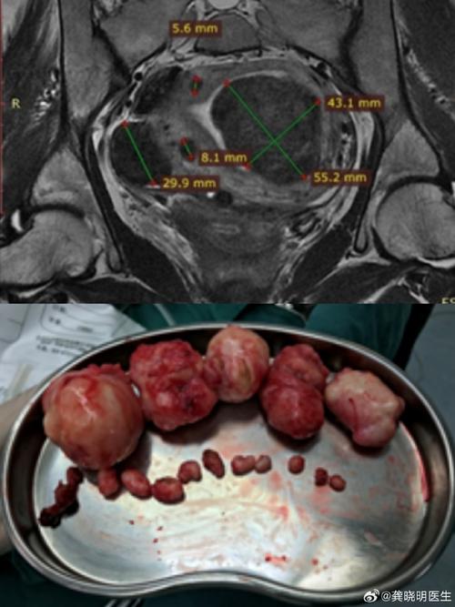 怀孕期间发现子宫肌瘤，会影响胎儿健康和分娩方式吗？-第2张图片-郑州医学网