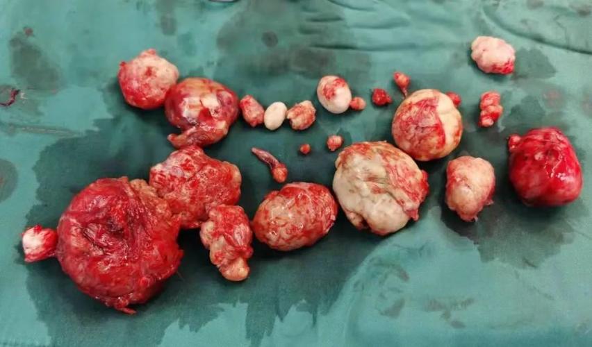 怀孕期间发现子宫肌瘤，会影响胎儿健康和分娩方式吗？-第3张图片-郑州医学网