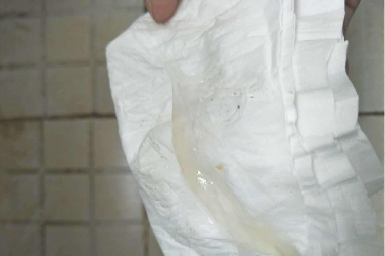 怀孕期间白带增多是正常现象还是异常信号？需要警惕哪些问题？-第1张图片-郑州医学网