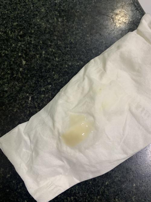 怀孕期间白带增多是正常现象还是异常信号？需要警惕哪些问题？-第2张图片-郑州医学网