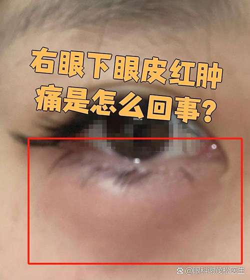 孕期下眼皮莫名红肿，是过敏还是炎症？孕期用药要怎么处理才安全？-第3张图片-郑州医学网
