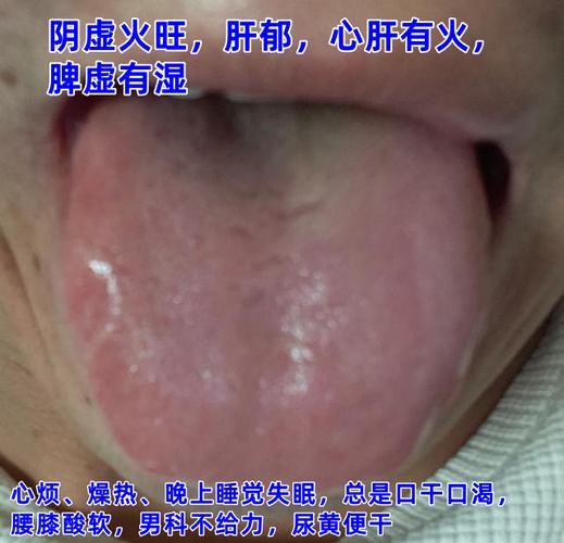 孕期早晨醒来总口干舌燥，是正常现象还是身体在报警？-第2张图片-郑州医学网