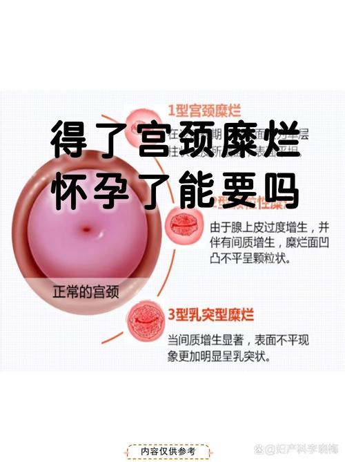 怀孕期间重度宫颈糜烂对胎儿有影响吗？该如何安全治疗？-第1张图片-郑州医学网