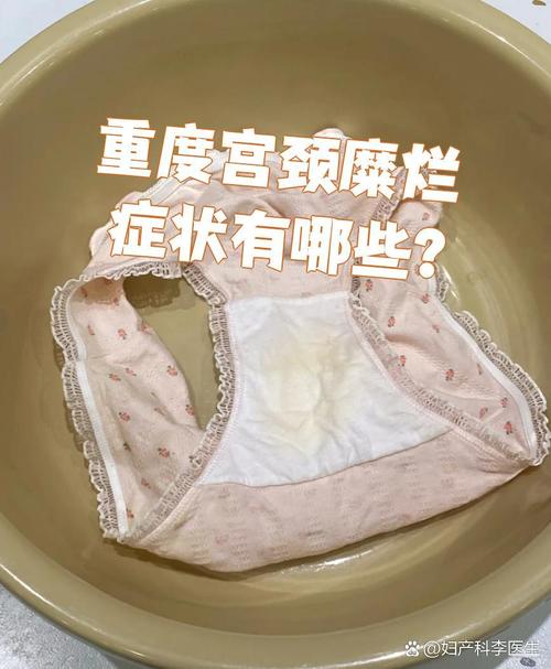 怀孕期间重度宫颈糜烂对胎儿有影响吗？该如何安全治疗？-第3张图片-郑州医学网