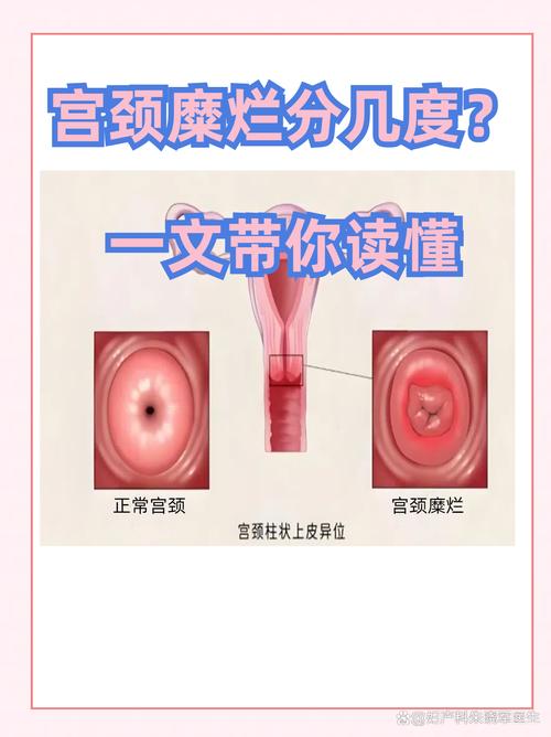 怀孕期间重度宫颈糜烂对胎儿有影响吗？该如何安全治疗？-第2张图片-郑州医学网