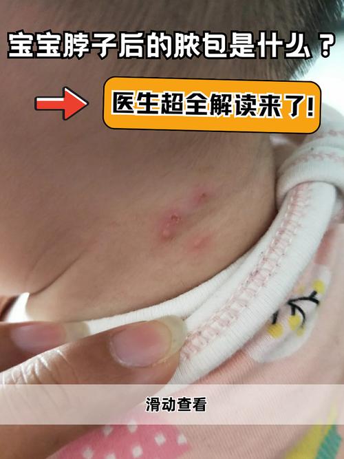 儿童热毒脓疮反复发作怎么办？如何安全有效治疗？-第1张图片-郑州医学网