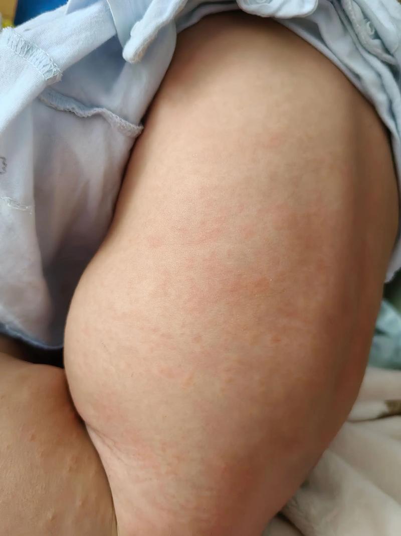 新生儿心肌炎早期症状隐匿，家长该如何捕捉这些不易察觉的信号？-第1张图片-郑州医学网