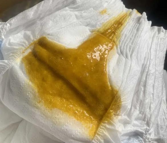 新生儿吃母乳后拉肚子，是母乳问题还是宝宝不适应？-第2张图片-郑州医学网