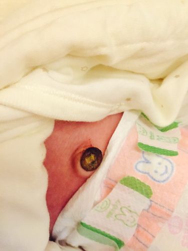 新生儿肚脐脱落后渗液正常吗？需要处理吗？-第2张图片-郑州医学网