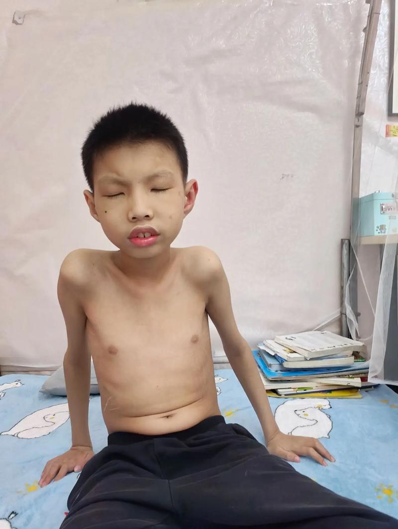 12岁儿童佝偻病驼背，是发育问题还是疾病信号？如何科学干预与矫正？-第3张图片-郑州医学网