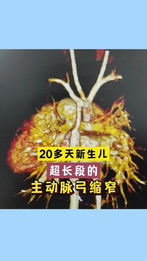 新生儿缺氧性肺动脉高压的发病机制与临床干预策略有哪些？-第2张图片-郑州医学网