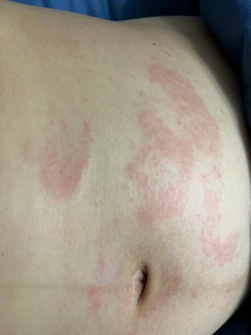 孕期胆酸高有什么症状-第1张图片-郑州医学网