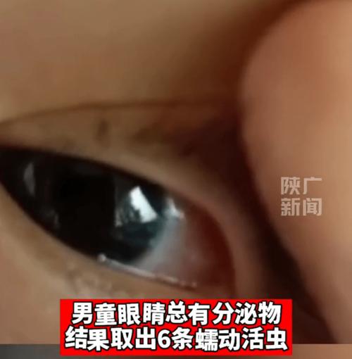 新生儿眼睛白色分泌物是正常现象还是疾病信号？需警惕哪些眼部问题？-第1张图片-郑州医学网