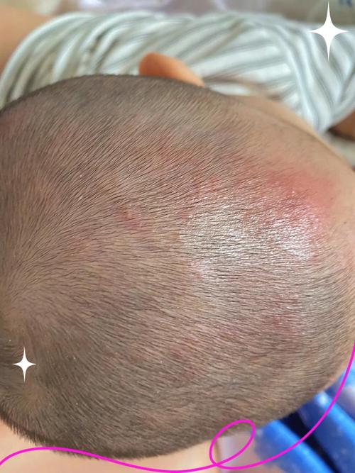 新生儿头上白色头皮屑-第1张图片-郑州医学网 新生儿头上白色头皮屑-第1张图片-郑州医学网