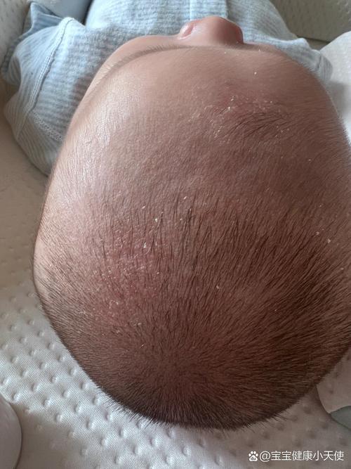 新生儿头上白色头皮屑-第2张图片-郑州医学网 新生儿头上白色头皮屑-第2张图片-郑州医学网