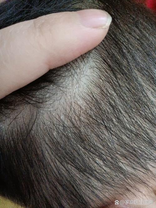 新生儿头上白色头皮屑-第3张图片-郑州医学网 新生儿头上白色头皮屑-第3张图片-郑州医学网