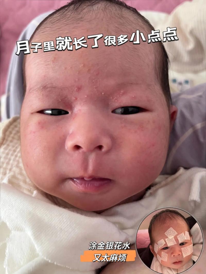 新生儿痤究竟能不能涂面霜?哪种面霜才安全有效?-第1张图片-郑州医学网 新生儿痤究竟能不能涂面霜?哪种面霜才安全有效?-第1张图片-郑州医学网