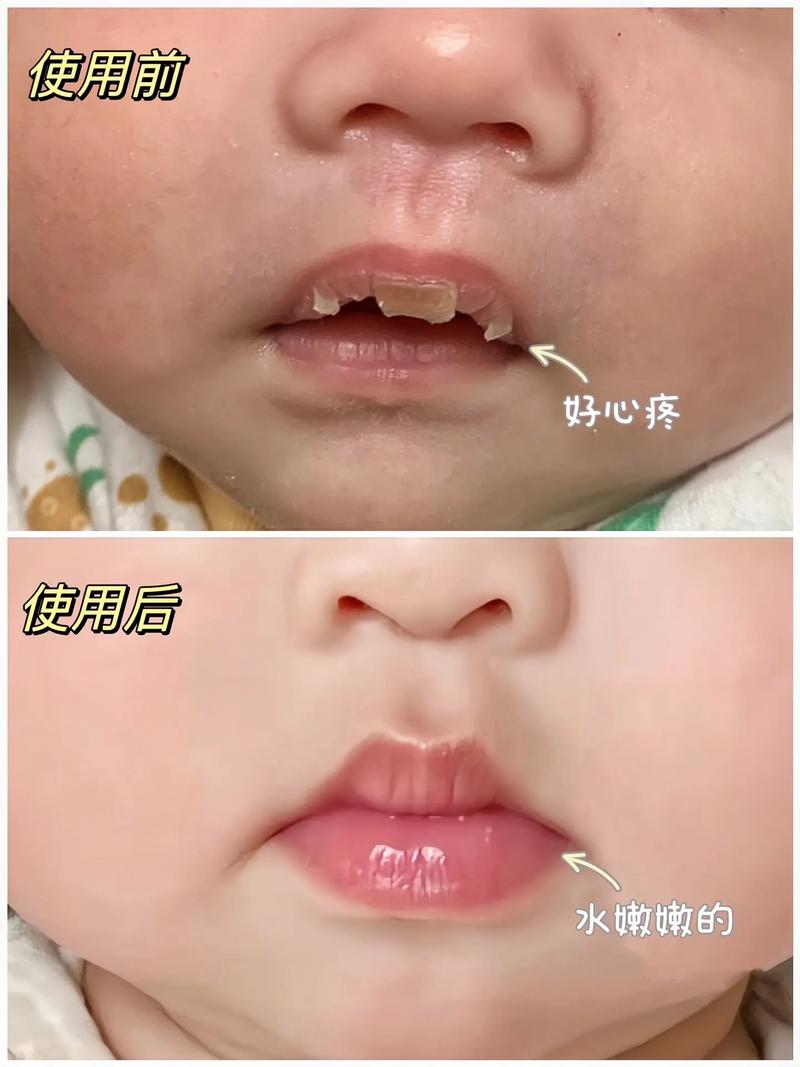 儿童嘴唇干是缺水还是生病了?日常护理要注意什么?-第1张图片-郑州医学网 儿童嘴唇干是缺水还是生病了?日常护理要注意什么?-第1张图片-郑州医学网