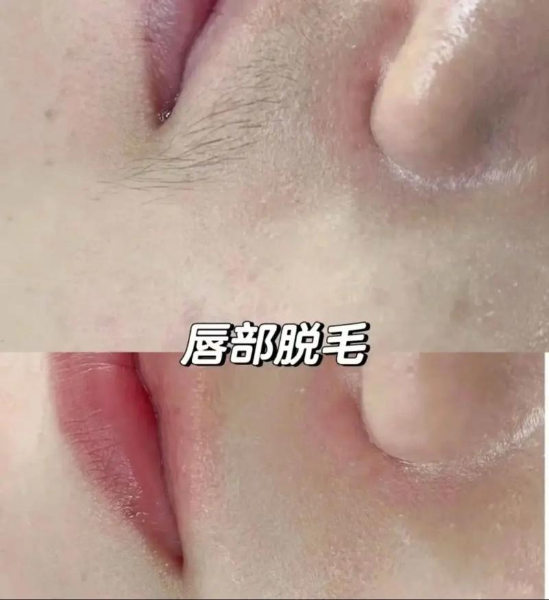 备孕期能做冰点脱毛吗？会对胎儿有影响吗？-第2张图片-郑州医学网