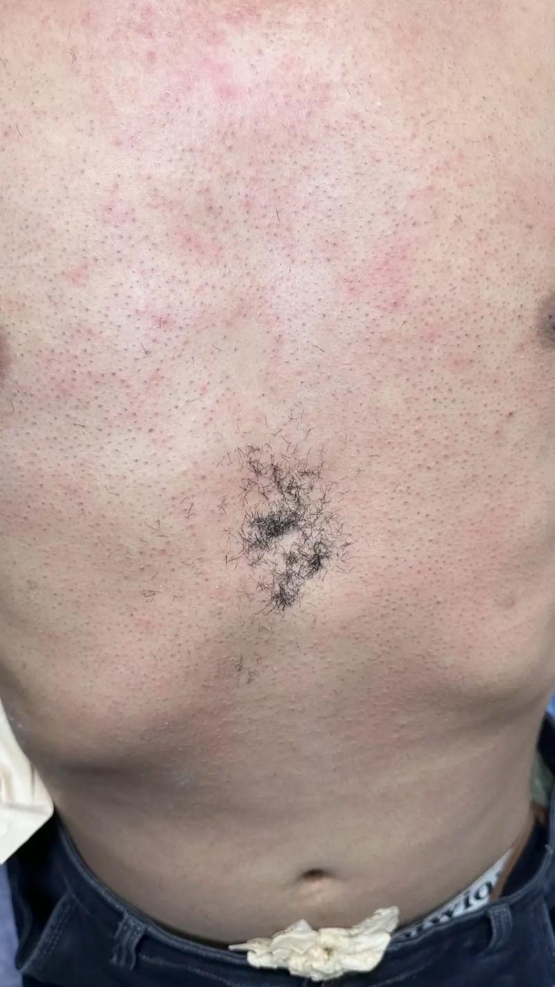 备孕期能做冰点脱毛吗？会对胎儿有影响吗？-第3张图片-郑州医学网