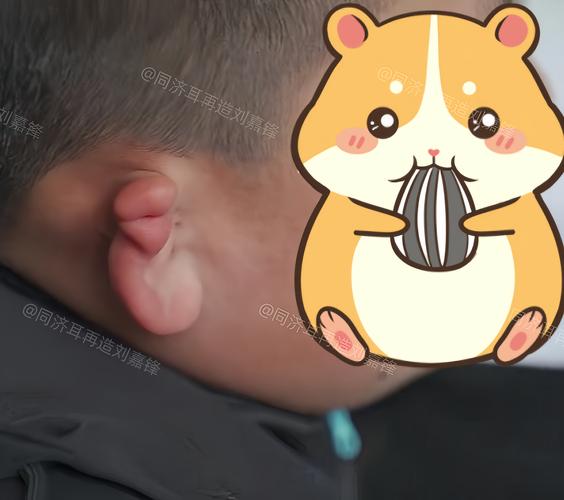 新生儿耳朵受压变形后能自行恢复吗？家长需要如何护理才不会影响正常发育？-第1张图片-郑州医学网