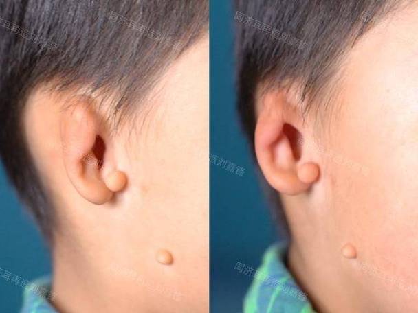 新生儿耳朵受压变形后能自行恢复吗？家长需要如何护理才不会影响正常发育？-第2张图片-郑州医学网