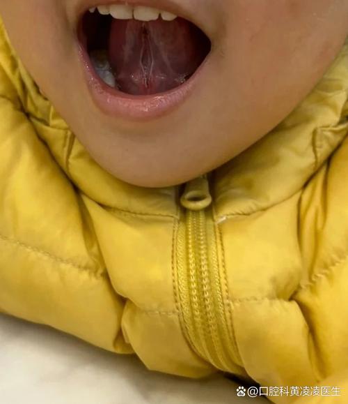 儿童舌头短一定是说话不清楚的主因吗？如何判断与科学干预？-第1张图片-郑州医学网