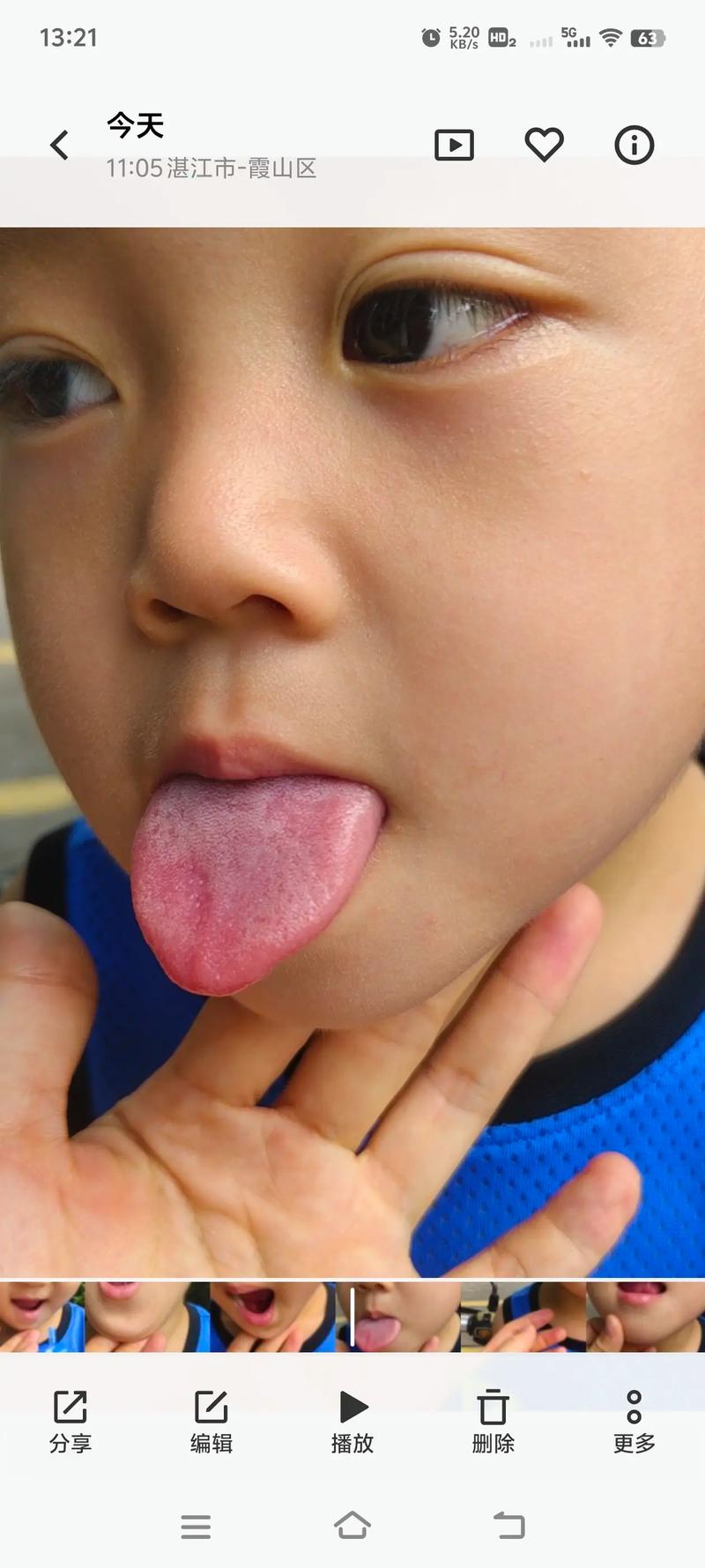 儿童舌头短一定是说话不清楚的主因吗？如何判断与科学干预？-第2张图片-郑州医学网