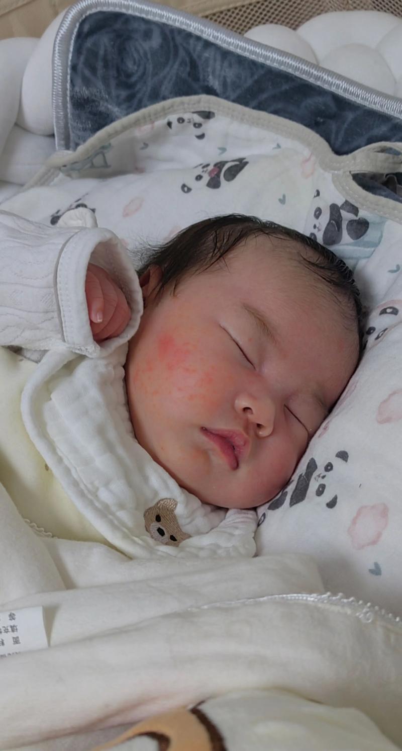 新生儿额头长满小红点是湿疹还是其他皮肤问题?需要治疗吗?-第1张图片-郑州医学网 新生儿额头长满小红点是湿疹还是其他皮肤问题?需要治疗吗?-第1张图片-郑州医学网