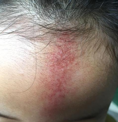 新生儿额头长满小红点是湿疹还是其他皮肤问题？需要治疗吗？-第2张图片-郑州医学网