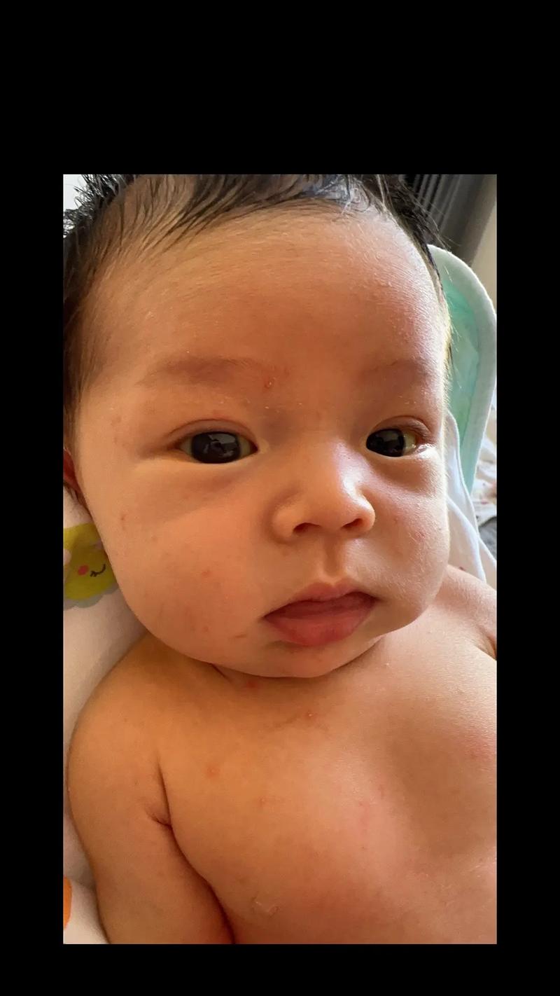 新生儿额头长满小红点是湿疹还是其他皮肤问题?需要治疗吗?-第3张图片-郑州医学网 新生儿额头长满小红点是湿疹还是其他皮肤问题?需要治疗吗?-第3张图片-郑州医学网