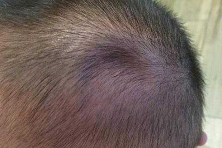 新生儿额头上面有凹陷是正常现象还是异常信号？需要警惕哪些潜在问题？-第2张图片-郑州医学网