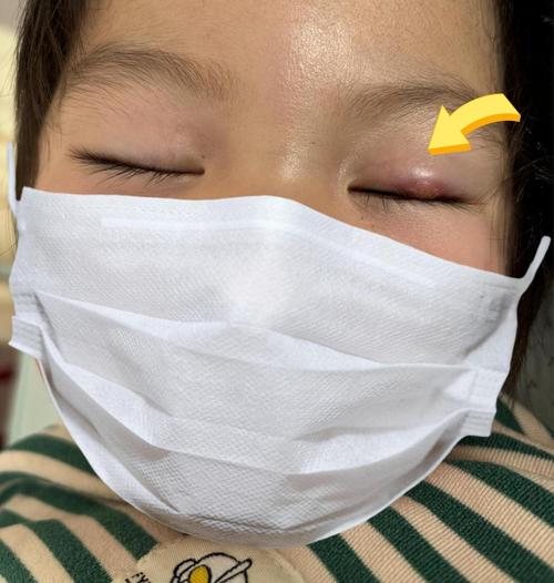 新生儿眼睛肿得睁不开，是正常生理现象还是需要紧急处理的信号？-第1张图片-郑州医学网