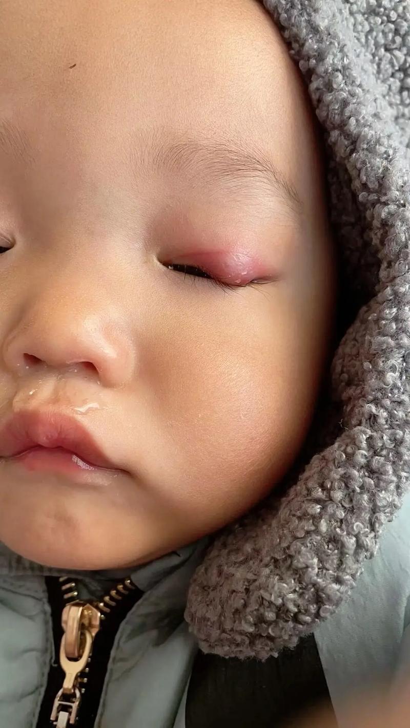 新生儿眼睛肿得睁不开，是正常生理现象还是需要紧急处理的信号？-第2张图片-郑州医学网