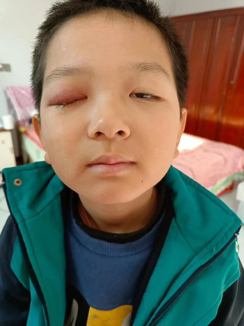 新生儿眼睛肿得睁不开，是正常生理现象还是需要紧急处理的信号？-第3张图片-郑州医学网