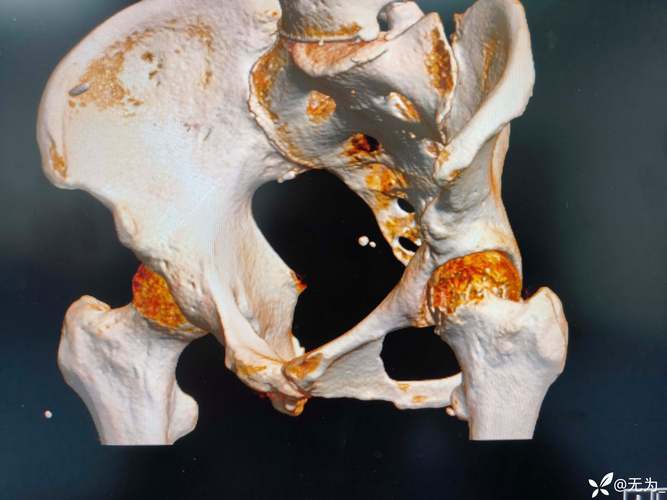13岁儿童股骨颈骨折该如何治疗？后续康复与发育风险大吗？-第1张图片-郑州医学网