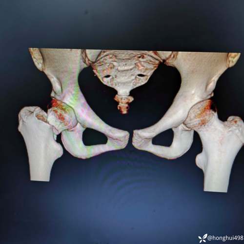 13岁儿童股骨颈骨折该如何治疗？后续康复与发育风险大吗？-第2张图片-郑州医学网