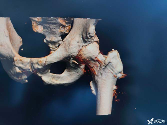 13岁儿童股骨颈骨折该如何治疗？后续康复与发育风险大吗？-第3张图片-郑州医学网