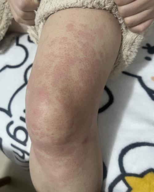 孕期身上起红疙瘩瘙痒，是过敏还是妊娠特有皮肤问题？-第1张图片-郑州医学网