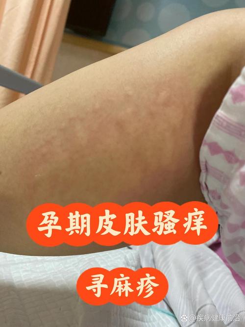 孕期身上起红疙瘩瘙痒，是过敏还是妊娠特有皮肤问题？-第2张图片-郑州医学网